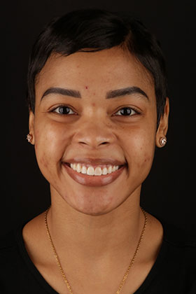 Brightened smile of a patient following professional gum depigmentation treatment.